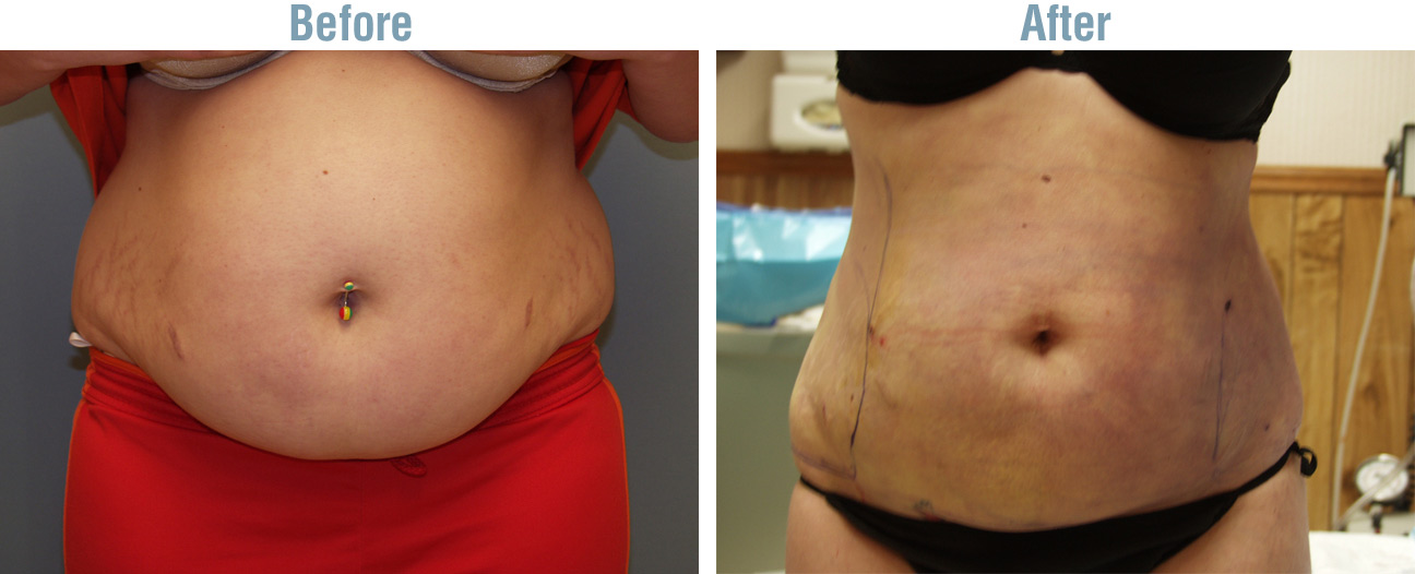 Dayton Liposuction Before and After Photo 61