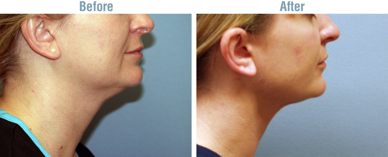 Neck Lift Surgery Before and After