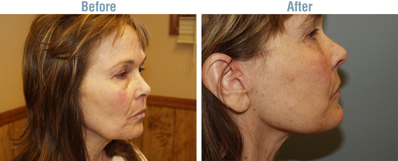 Facelift Surgery Before and After