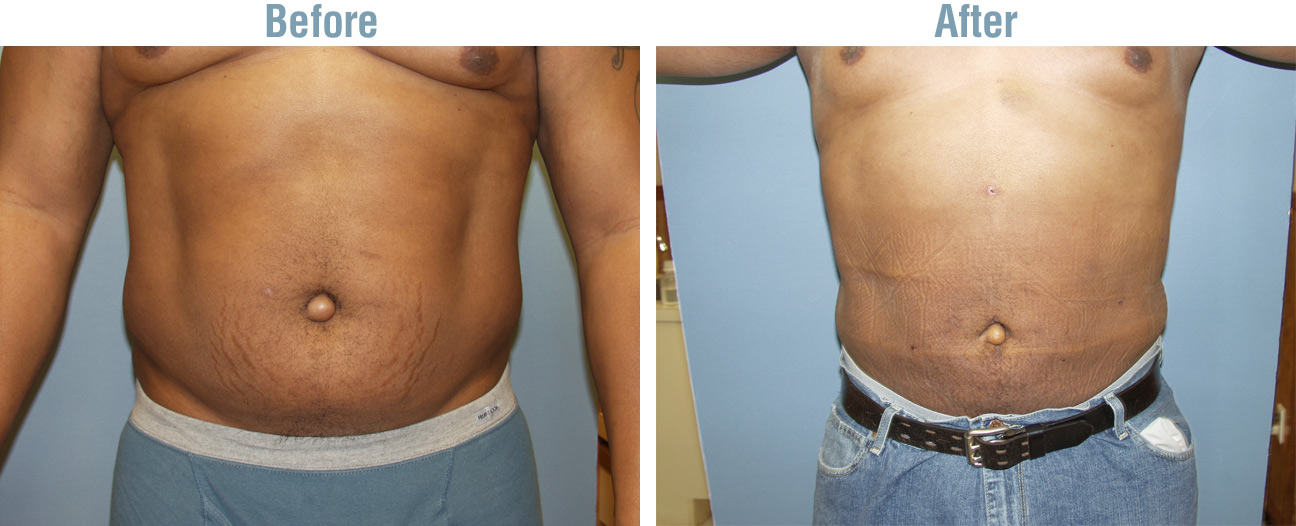 Dayton Liposuction Before and After Photo 1