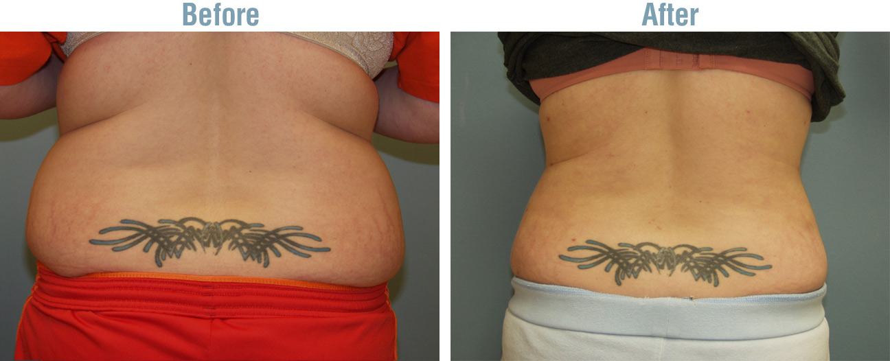 Laser Lipo Plus Before and After