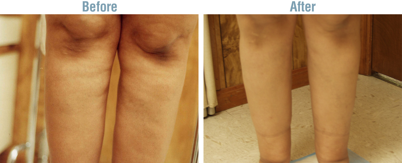 Laser Lipo Plus Before and After
