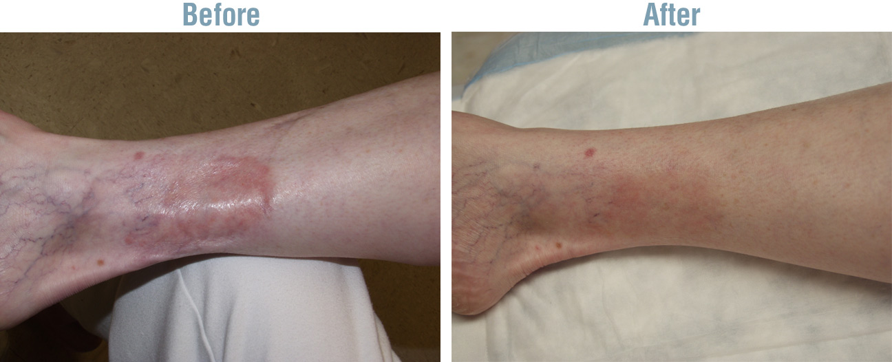 Vein Therapy Before and After