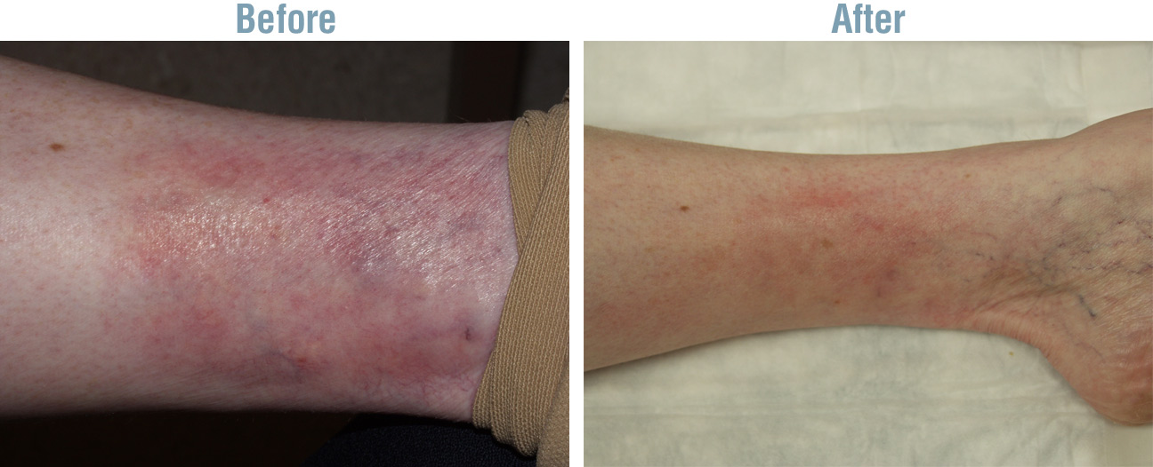 Endo Vein Treatment Before After 2