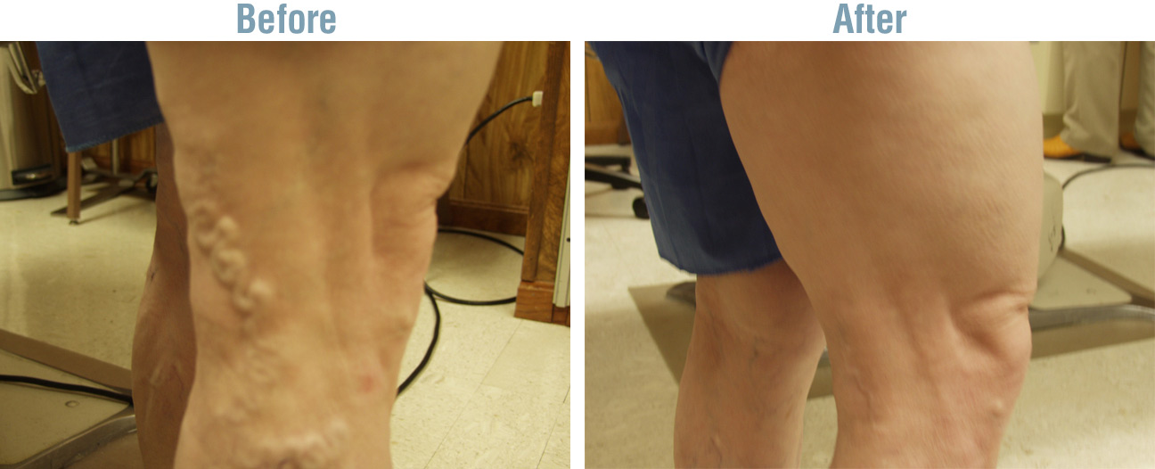 Vein Therapy Before and After
