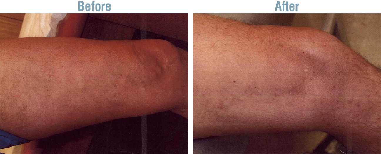 Phlebectomy Varicose Vein Therapy Before and After